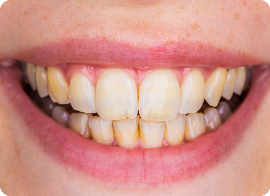 smile-before